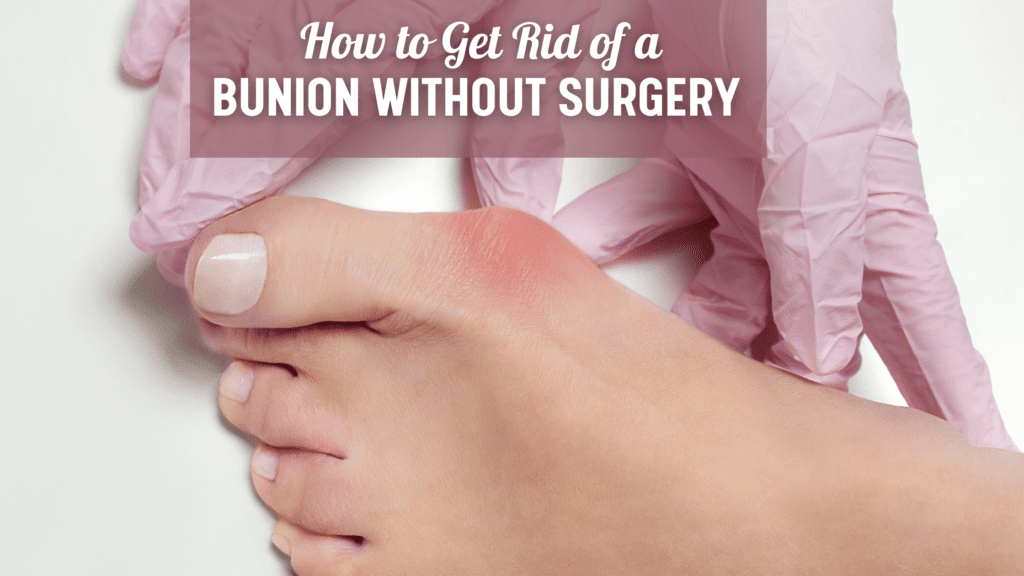 How To Get Rid Of A Bunion Without Surgery